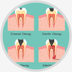 Abscessed Tooth Infection Treatment in Toronto