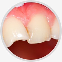 Broken Teeth Restoration & Treatment Toronto