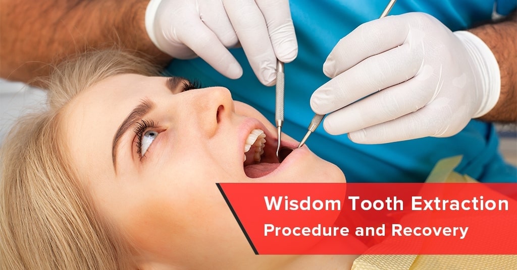 wisdom tooth extraction procedure and recovery