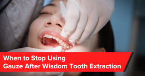 when to stop using gauze after wisdom tooth extraction