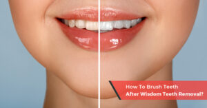 how to brush teeth after wisdom teeth removal