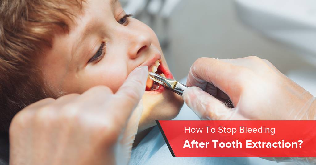 how to stop bleeding after tooth extraction