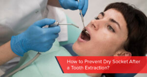how to prevent dry socket after a tooth extraction
